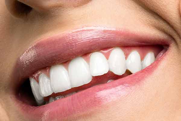 Cosmetic dental bonding veneers hawthorn