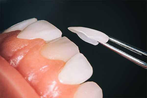 Cosmetic dental ceramic veneers hawthorn