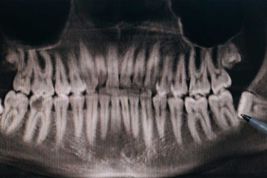 Wisdom Teeth